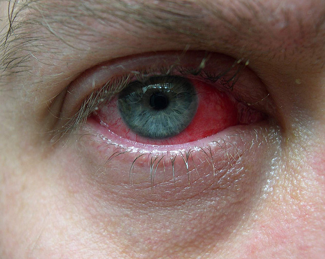 conjunctivitis-ten-random-facts